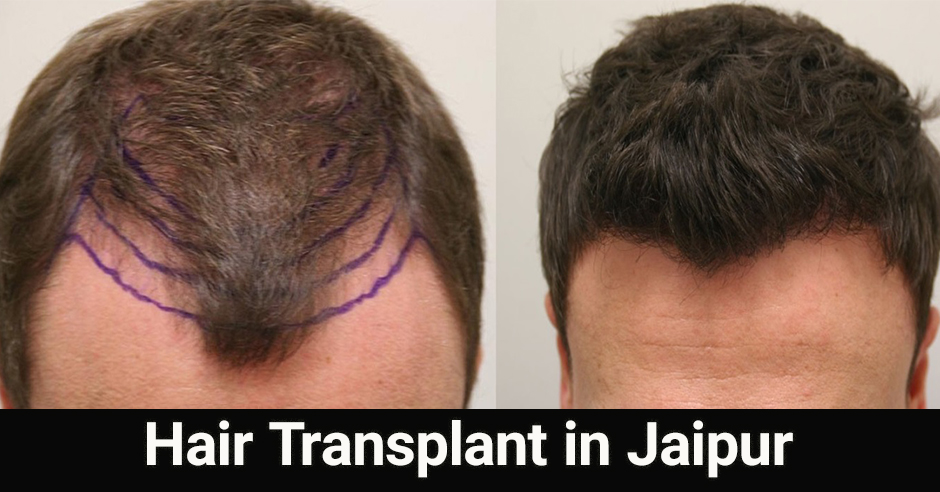 Hair Transplant Is The Procedure Of Regrowing Natural