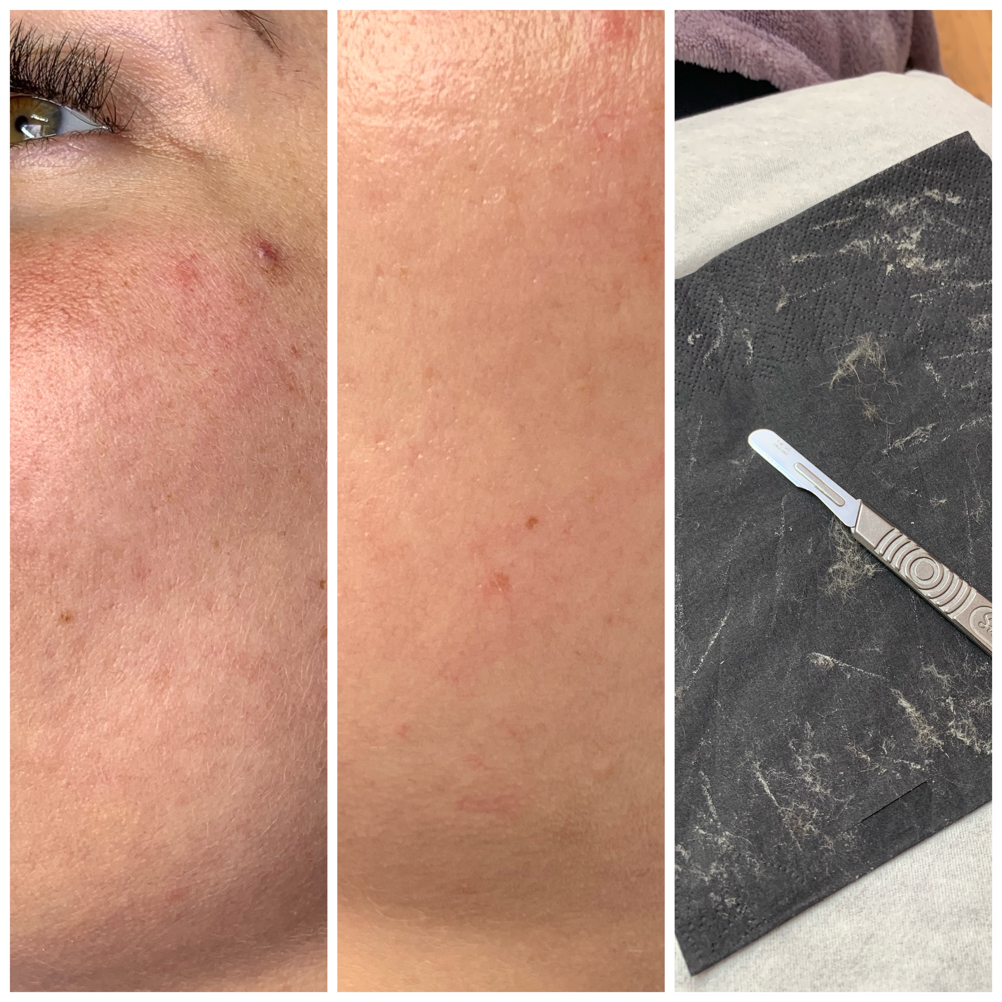 Derma Planing Glow Gregorysglamour Ultimate So Satisfyi