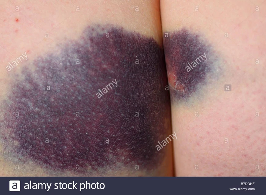 Warts on children Warts on children